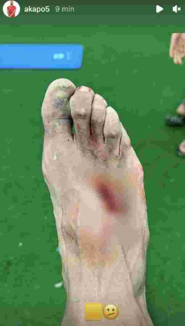 Akapo Real Madrid maçından sonra ayağının son halini paylaştı! Futbolseverler gözlerine inanamadı
