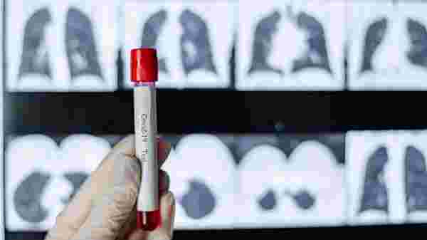 COVID-19 tanı sürecinde akciğer kanseri tanısı: Türkiye'ye tarama testi yapılmış oldu