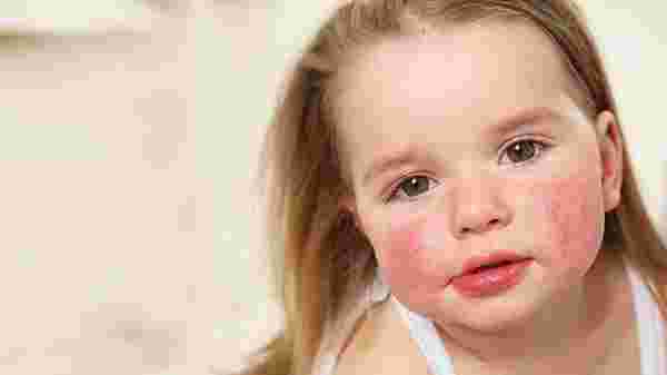 Anne ya da babasında alerji olan çocuklar risk altında