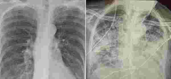 Koronavirüsün korkunç etkisi röntgen filmlerine de yansıdı: Sigara tiryakisinden kat kat daha kötü