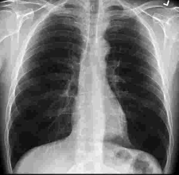 Koronavirüsün korkunç etkisi röntgen filmlerine de yansıdı: Sigara tiryakisinden kat kat daha kötü