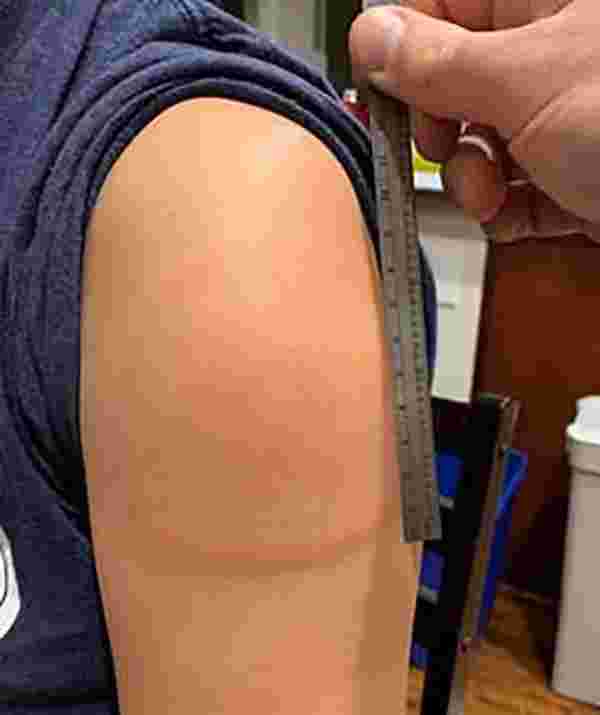 Moderna'nın koronavirüs aşısını yaptıran 14 kişinin kolunda ağrılı kırmızı şişlikler oluştu