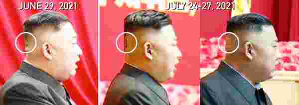 Kuzey Kore lideri Kim Jong-un kafasının arkası çürüdü