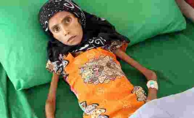 Bu Acıtan Kare Dünyanın Kör ve Sağır Kaldığı Yemen'den: 10 Kilo Ağırlığındaki Çocuk Tedavi Altına Alındı