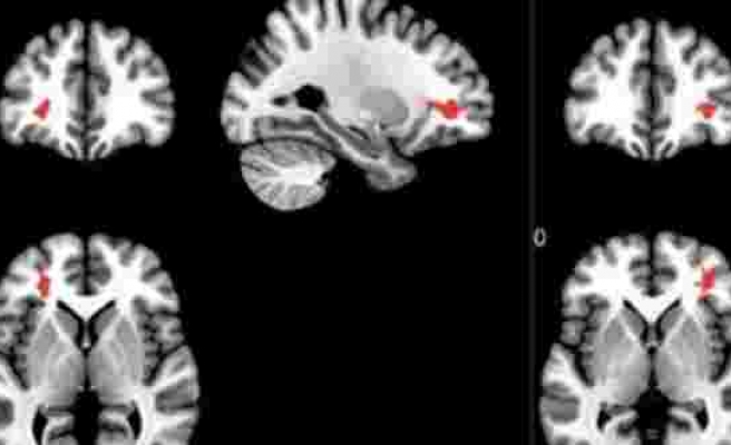 Covid-19 geçirenlerin beyinlerini incelediler: Endişe yaratan sonuç
