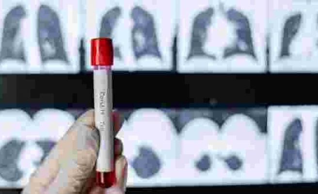 COVID-19 teşhis sürecinde akciğer kanseri tanısı: Türkiye’ye tarama testi üretilmiş oldu
