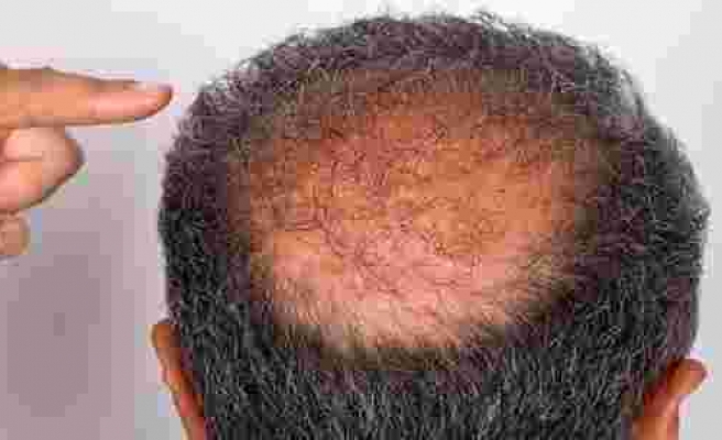 Dermatoloji Uzmanından Korkutan Açıkladı: Kovid-19 Geçirenlerde 'Saç Dökülmesi' Tehlikesi