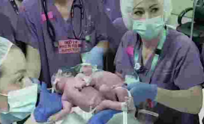 Dünyanın en zor ameliyatı: Bebeklerin kafalarını ayırdılar