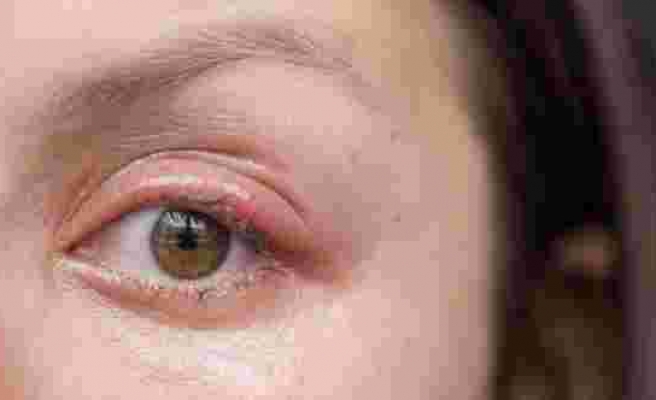Göz kapağı iltihabı nedir? Belirtileri ve tedavisi…