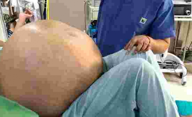 Hindistan'da bir kadından 54 kilogram tümör çıkarıldı