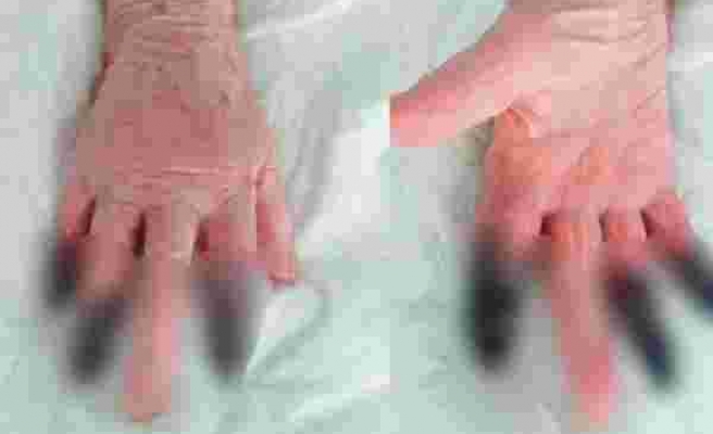 İtalya'da Koronavirüs Hastası Kadın Kangren Oldu, 3 Parmağı Kesildi