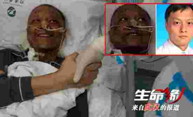 Koronavirüse yakalandıktan sonra ten rengi değişen Çinli doktor normale döndü
