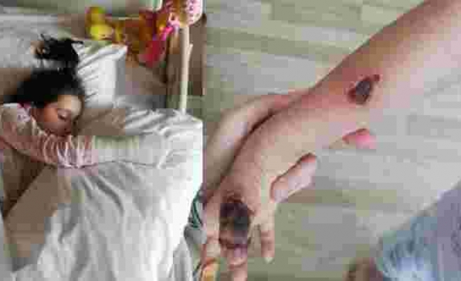 MR çekimi sırasında küçük kızın parmakları ve kolu yandı